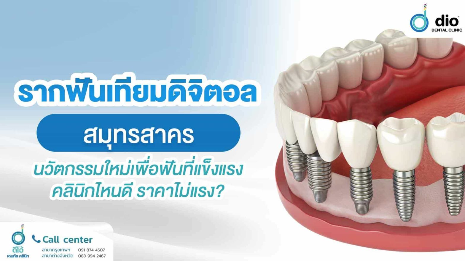 รากฟันเทียมดิจิตอล-สมุทรสาคร-นวัตกรรมใหม่เพื่อฟันที่แข็งแรง-คลินิกไหนดี-ราคาไม่แรง-