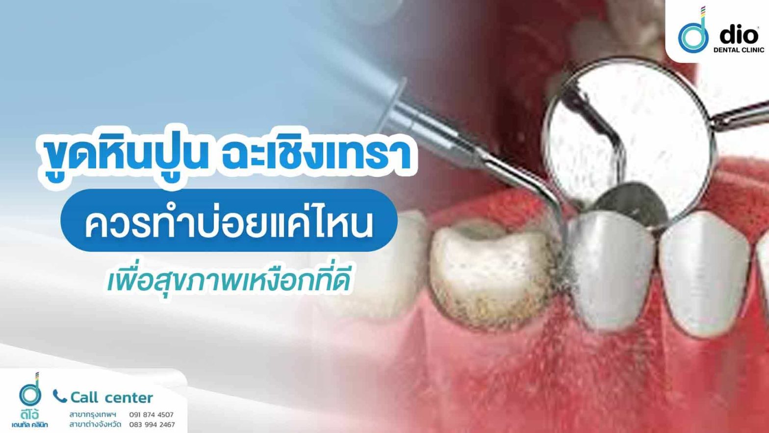 ขูดหินปูน-ฉะเชิงเทรา-ควรทำบ่อยแค่ไหน-เพื่อสุขภาพเหงือกที่ดี