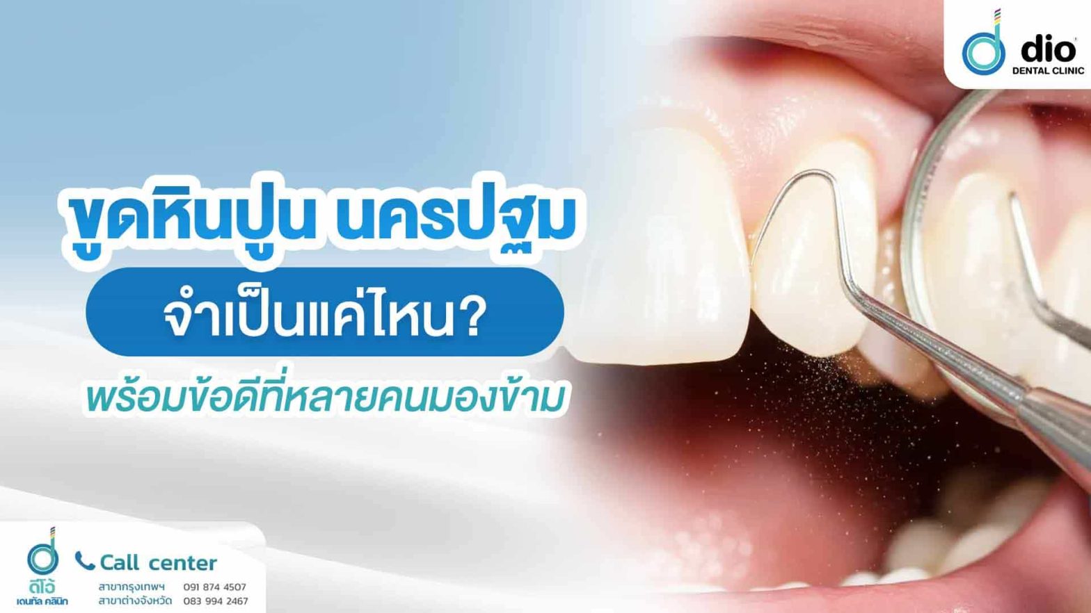 ขูดหินปูน-นครปฐม-จำเป็นแค่ไหน - พร้อมข้อดีที่หลายคนมองข้าม
