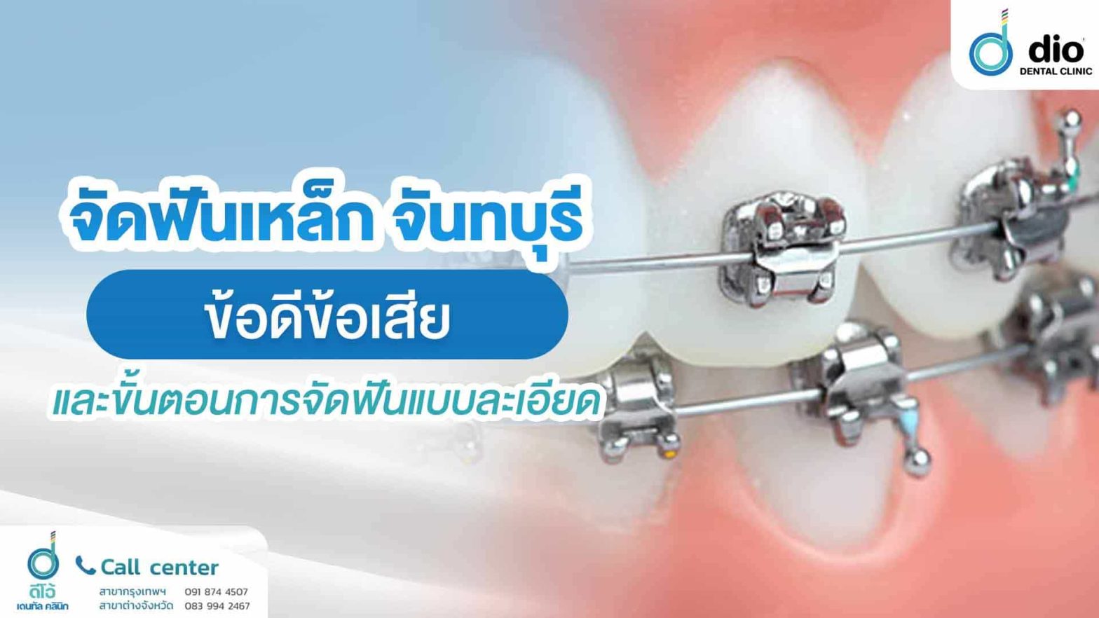 จัดฟันเหล็ก-จันทบุรี-ข้อดีข้อเสีย-และขั้นตอนการจัดฟันแบบละเอียด