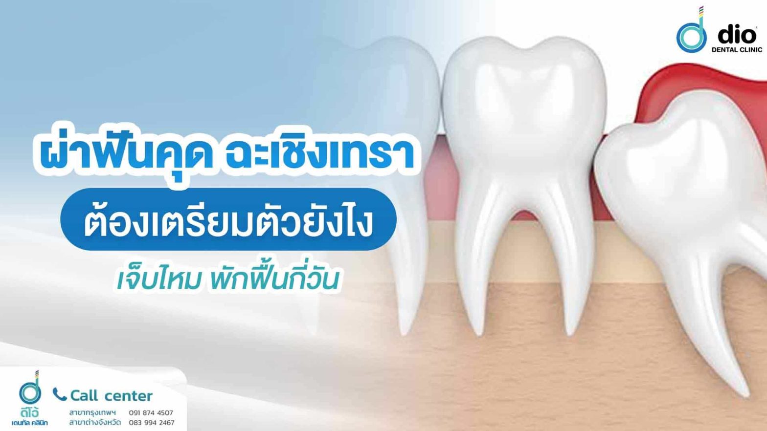 ผ่าฟันคุด-ฉะเชิงเทรา-ต้องเตรียมตัวยังไง-เจ็บไหม-พักฟื้นกี่วัน