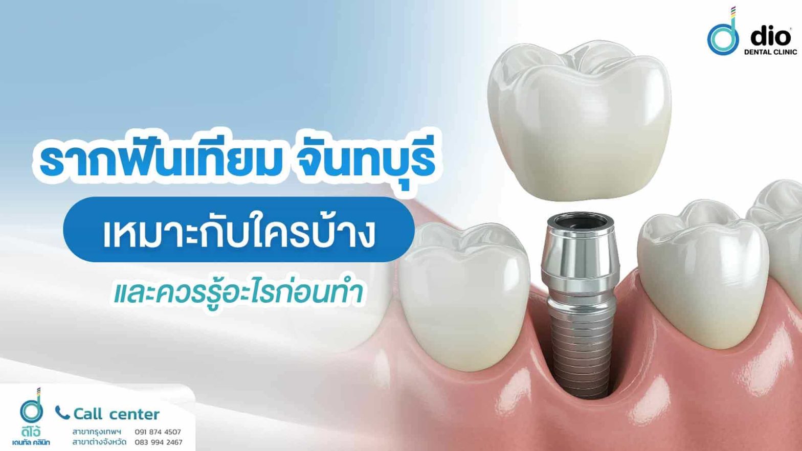 รากฟันเทียม-จันทบุรี-เหมาะกับใครบ้าง-และควรรู้อะไรก่อนทำ