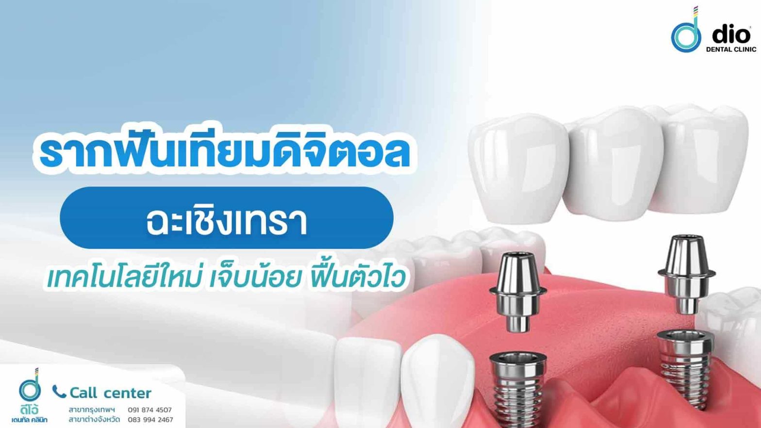 รากฟันเทียมดิจิตอล-ฉะเชิงเทรา-เทคโนโลยีใหม่-เจ็บน้อย-ฟื้นตัวไว