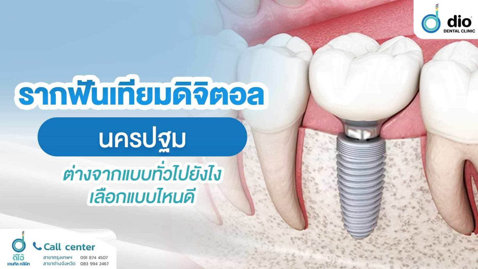 รากฟันเทียมดิจิตอล-นครปฐม-ต่างจากแบบทั่วไปยังไง-เลือกแบบไหนดี