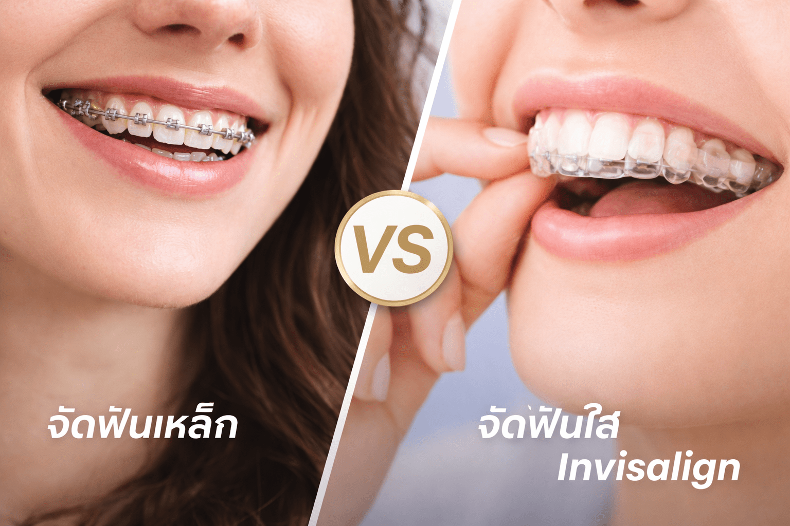 จัดฟันใส Invisalign VS. จัดฟันเหล็ก