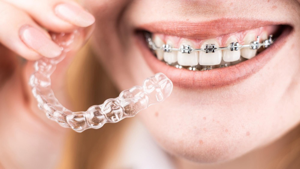 จัดฟันใส Invisalign กับจัดฟันเหล็ก