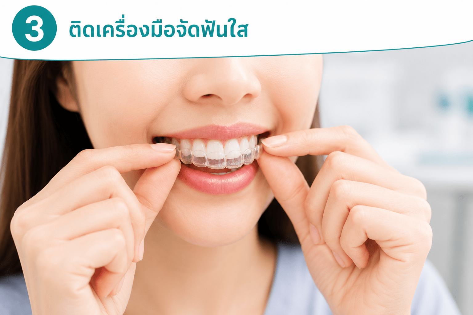 ติดเครื่องมือจัดฟันใส