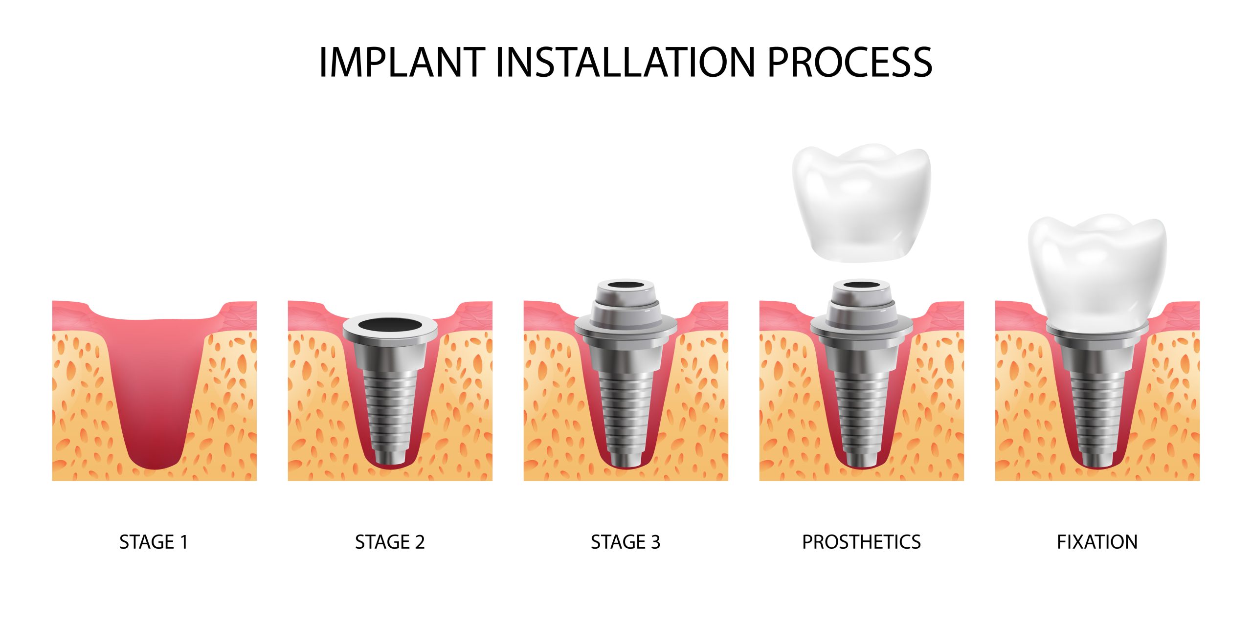 Implant Installation Stages