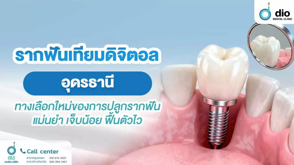 รากฟันเทียมดิจิตอล อุดรธานี ทางเลือกใหม่ของการปลูกรากฟันแม่นยำ เจ็บน้อย ฟื้นตัวไว