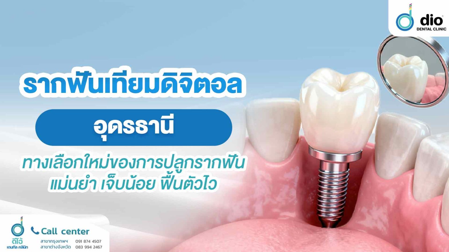 รากฟันเทียมดิจิตอล อุดรธานี ทางเลือกใหม่ของการปลูกรากฟันแม่นยำ เจ็บน้อย ฟื้นตัวไว
