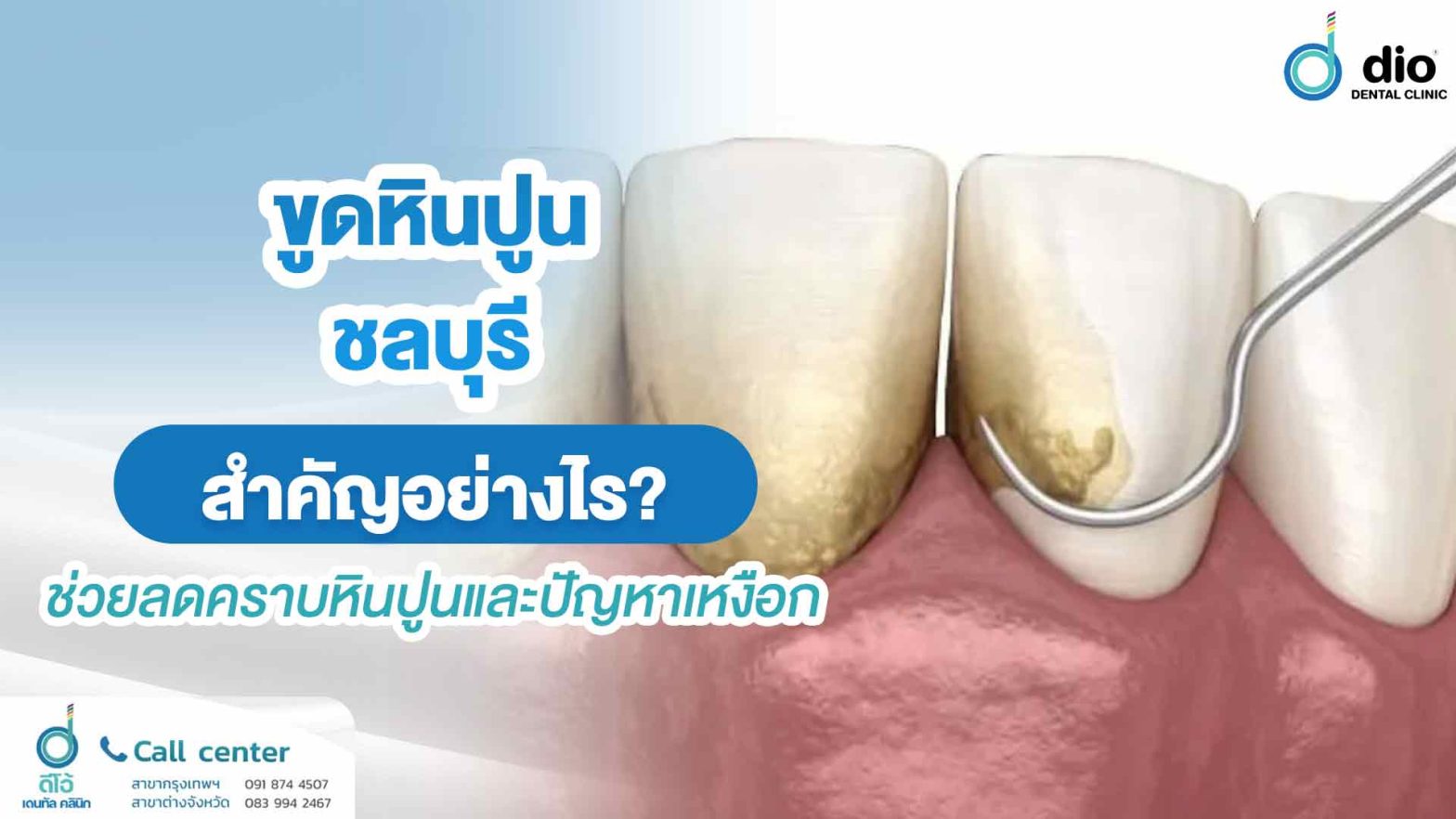 ขูดหินปูน ชลบุรี สำคัญอย่างไร? ช่วยลดคราบหินปูนและปัญหาเหงือก