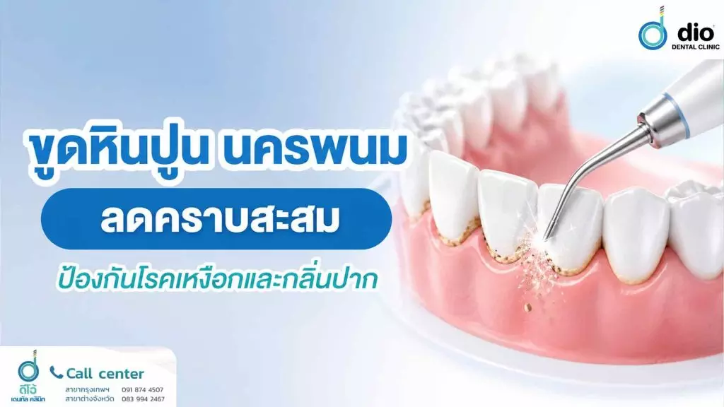ขูดหินปูน นครพนม ลดคราบสะสม ป้องกันโรคเหงือกและกลิ่นปาก
