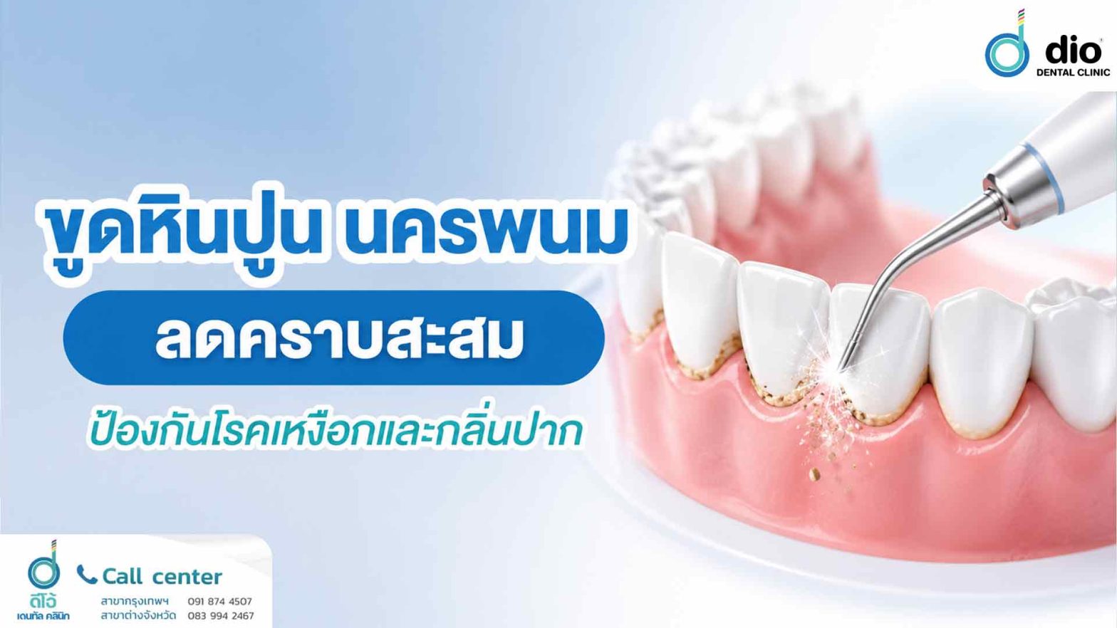 ขูดหินปูน นครพนม ลดคราบสะสม ป้องกันโรคเหงือกและกลิ่นปาก