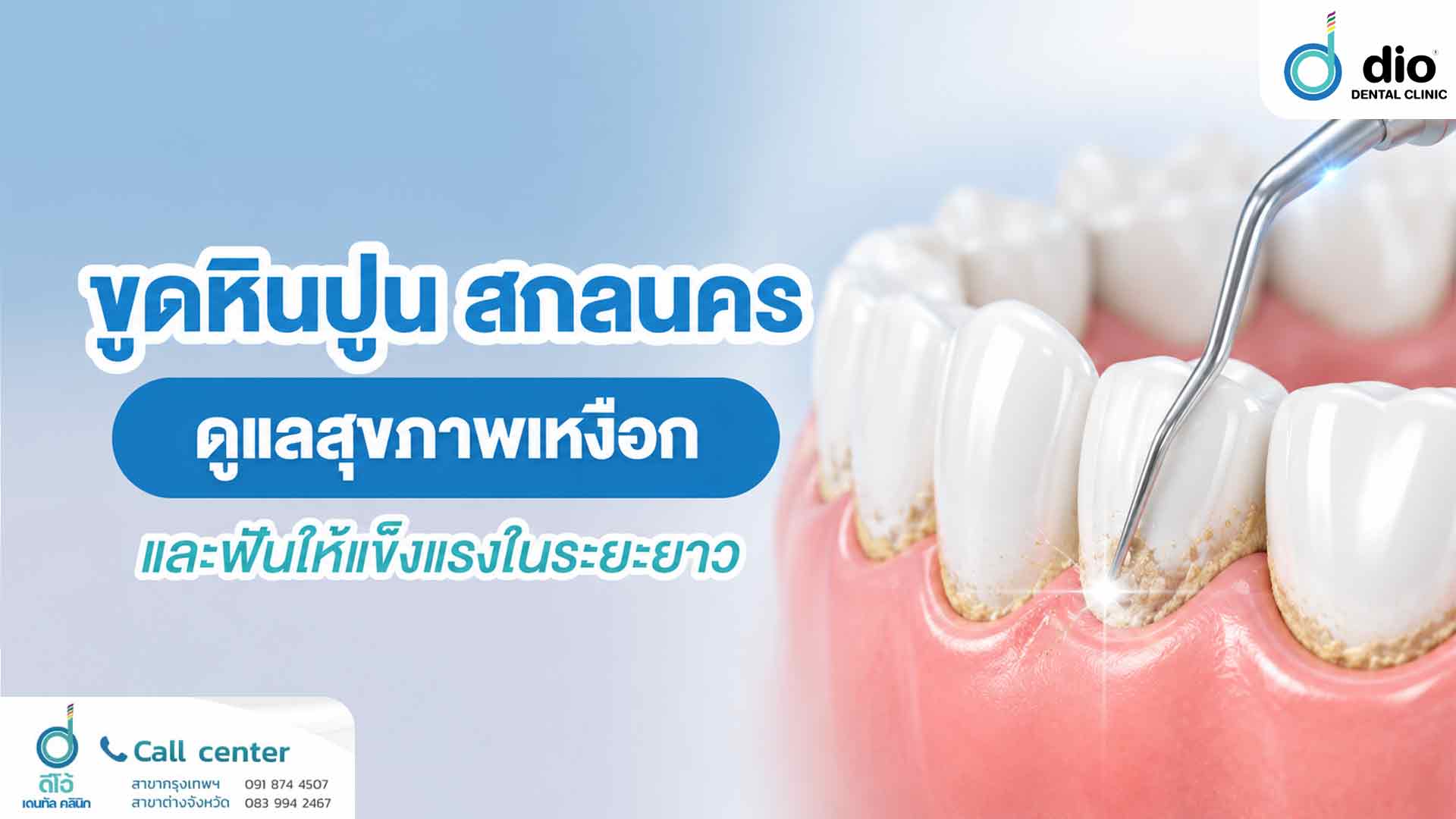 ขูดหินปูน สกลนคร ดูแลสุขภาพเหงือกและฟันให้แข็งแรงในระยะยาว