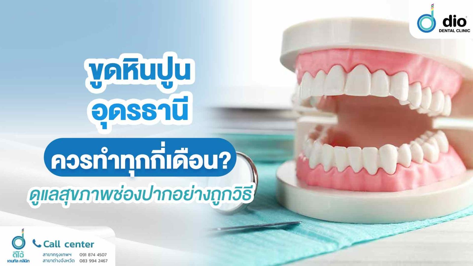 ขูดหินปูน อุดรธานี ควรทำทุกกี่เดือน? ดูแลสุขภาพช่องปากอย่างถูกวิธี
