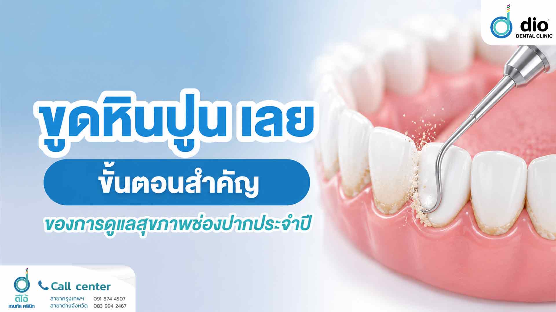 ขูดหินปูน เลย ขั้นตอนสำคัญของการดูแลสุขภาพช่องปากประจำปี