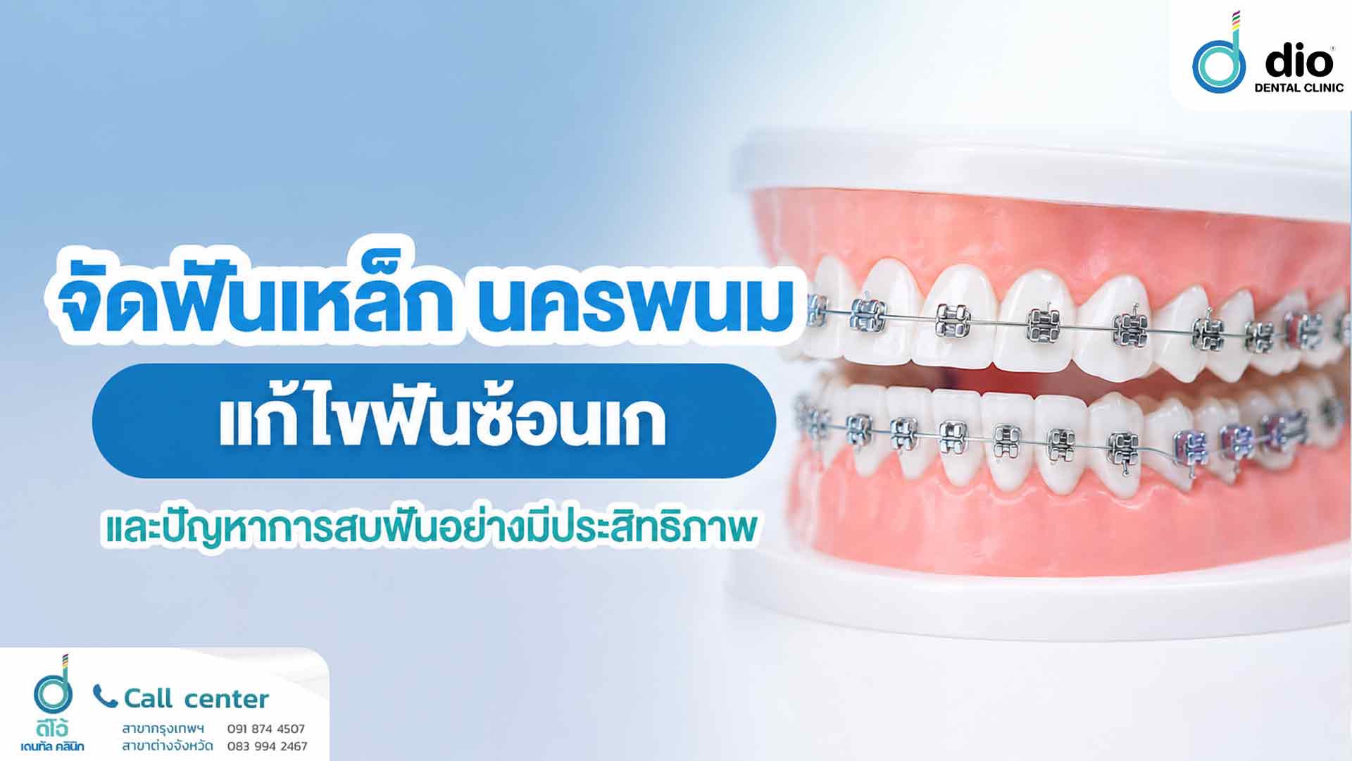 จัดฟันเหล็ก นครพนม แก้ไขฟันซ้อนเกและปัญหาการสบฟันอย่างมีประสิทธิภาพ