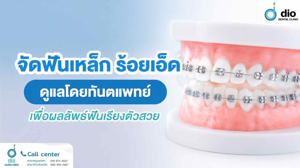 จัดฟันเหล็ก ร้อยเอ็ด ดูแลโดยทันตแพทย์เพื่อผลลัพธ์ฟันเรียงตัวสวย