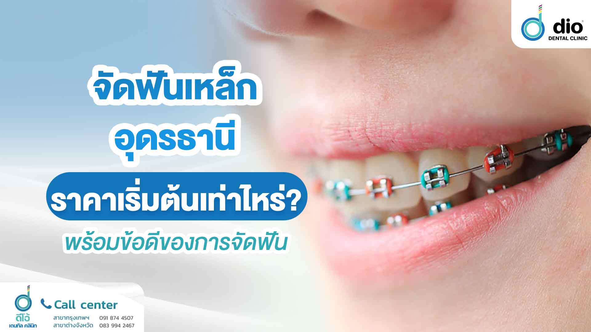 จัดฟันเหล็ก อุดรธานี ราคาเริ่มต้นเท่าไหร่? พร้อมข้อดีของการจัดฟัน