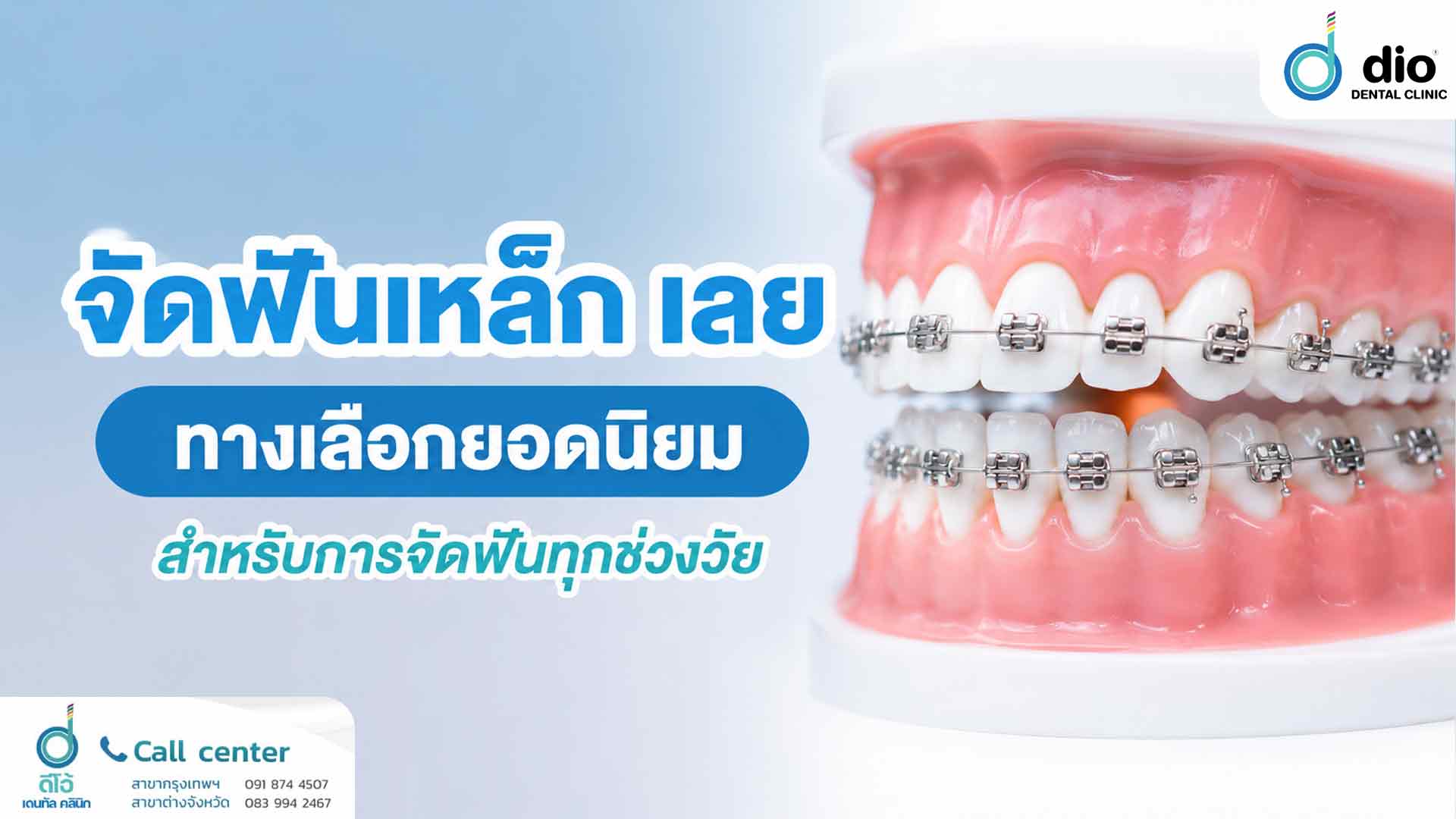 จัดฟันเหล็ก เลย ทางเลือกยอดนิยมสำหรับการจัดฟันทุกช่วงวัย