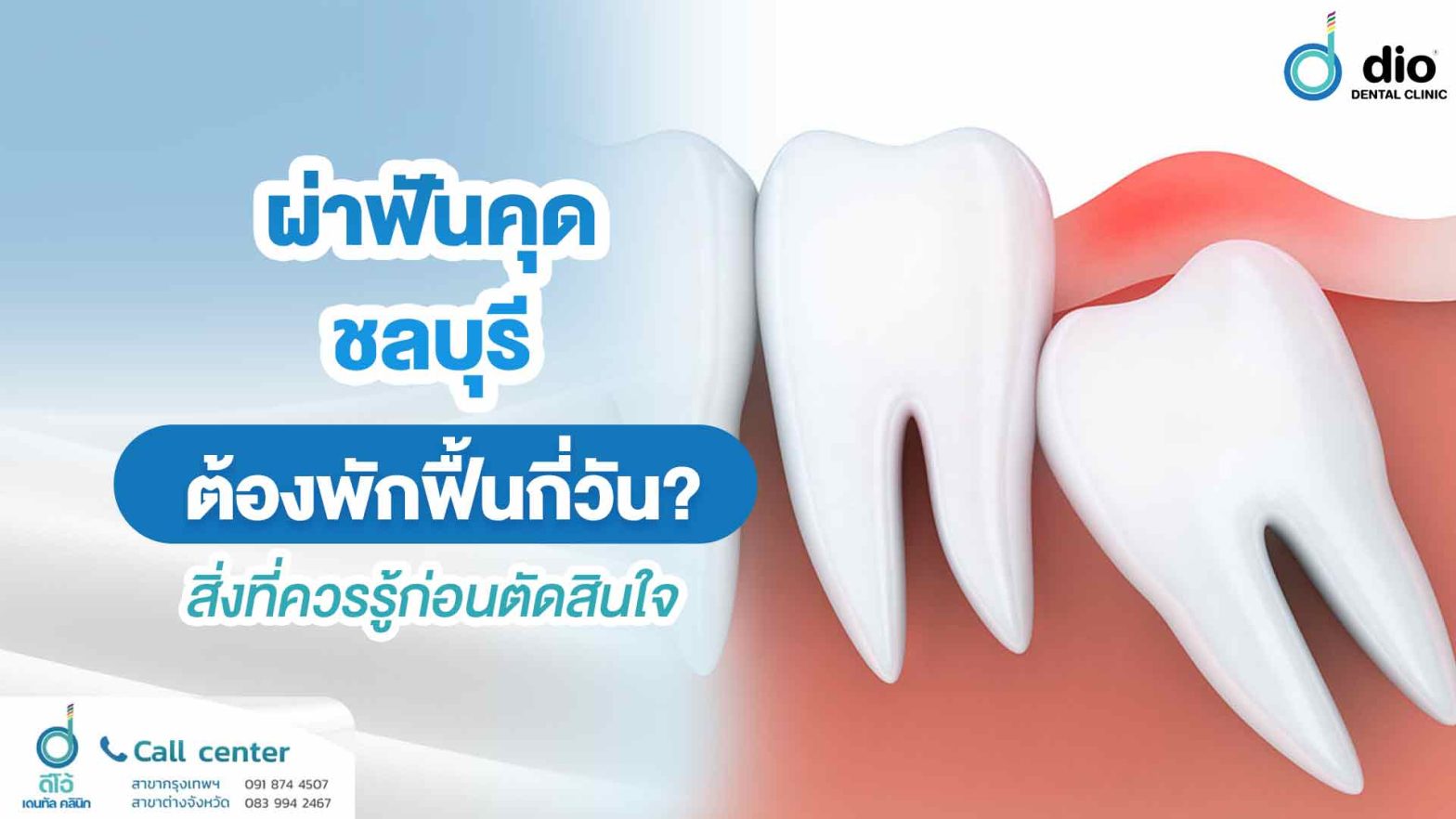 ผ่าฟันคุด ชลบุรี ต้องพักฟื้นกี่วัน? สิ่งที่ควรรู้ก่อนตัดสินใจ