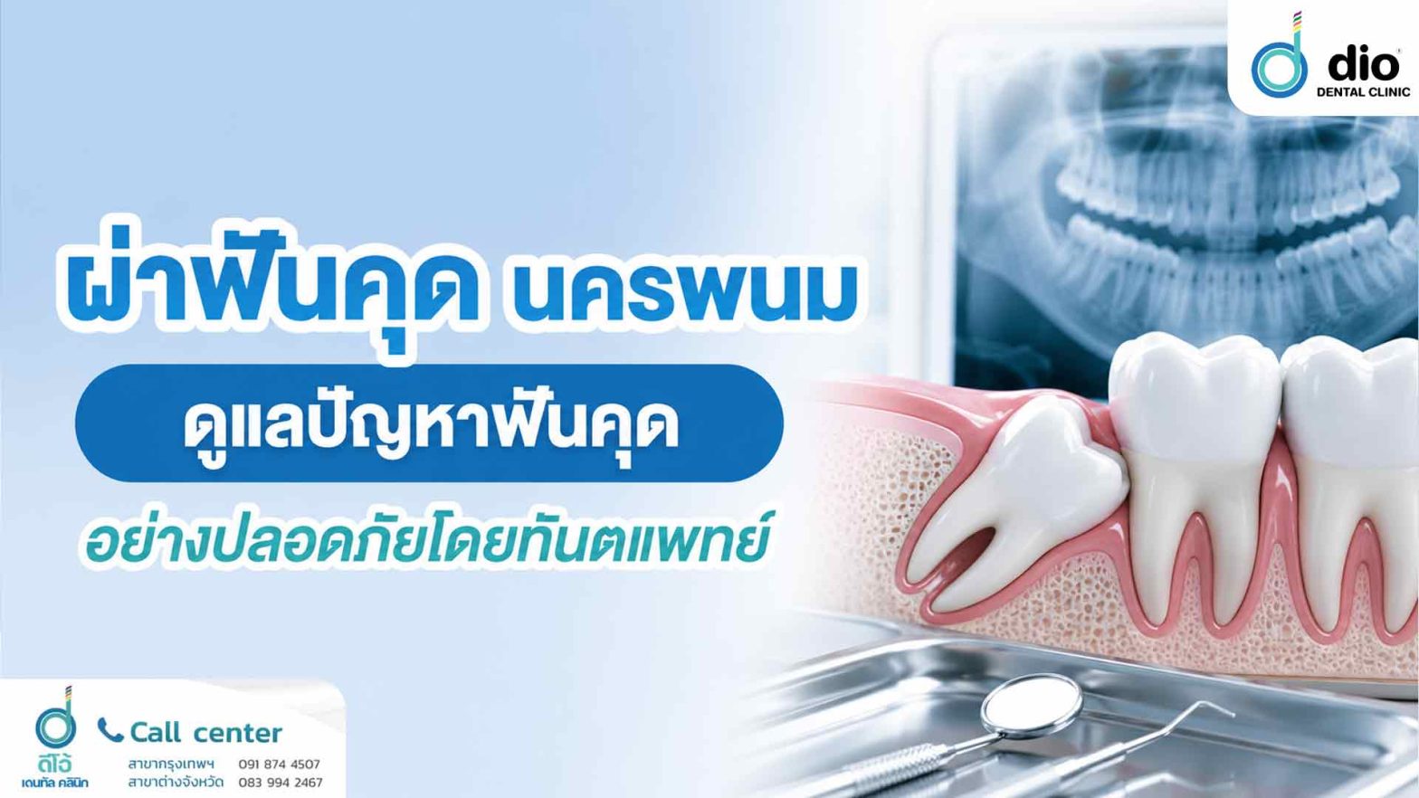 ผ่าฟันคุด นครพนม ดูแลปัญหาฟันคุดอย่างปลอดภัยโดยทันตแพทย์