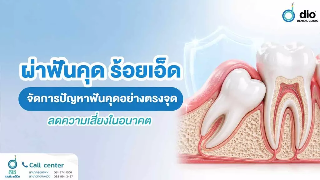 ผ่าฟันคุด ร้อยเอ็ด จัดการปัญหาฟันคุดอย่างตรงจุด ลดความเสี่ยงในอนาคต