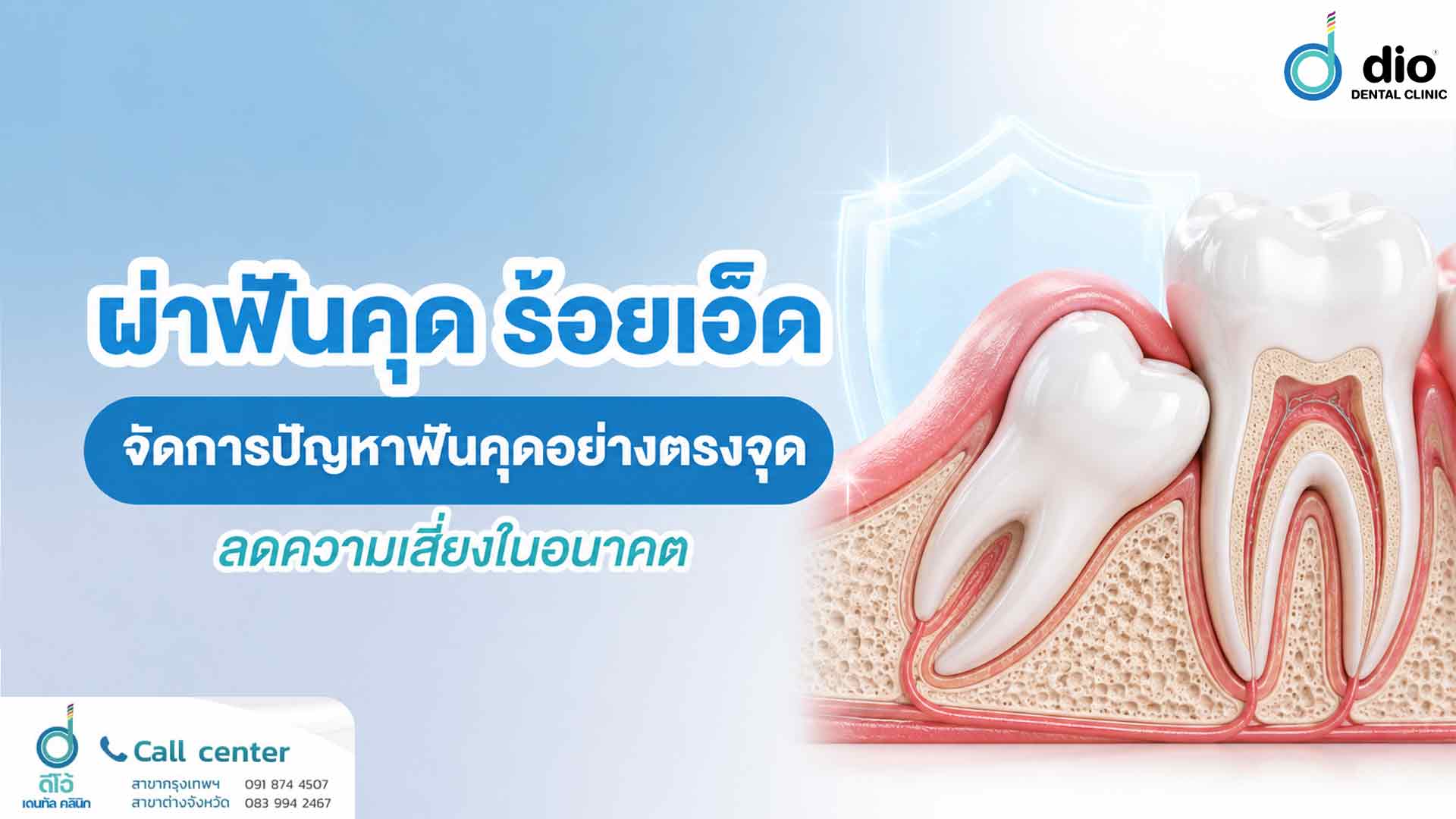 ผ่าฟันคุด ร้อยเอ็ด จัดการปัญหาฟันคุดอย่างตรงจุด ลดความเสี่ยงในอนาคต