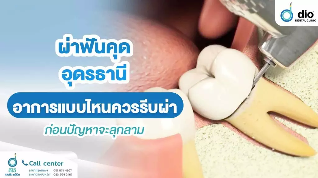 ผ่าฟันคุด อุดรธานี คลินิกไหนดี ฟันคุดแบบไหนควรรีบผ่า ก่อนปัญหาจะลุกลาม