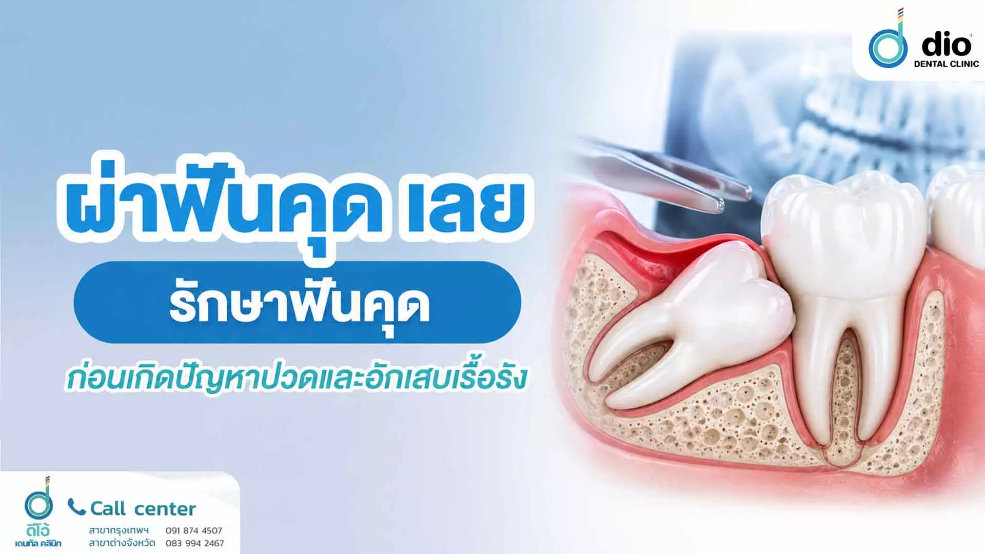 ผ่าฟันคุด เลย รักษาฟันคุดก่อนเกิดปัญหาปวดและอักเสบเรื้อรัง