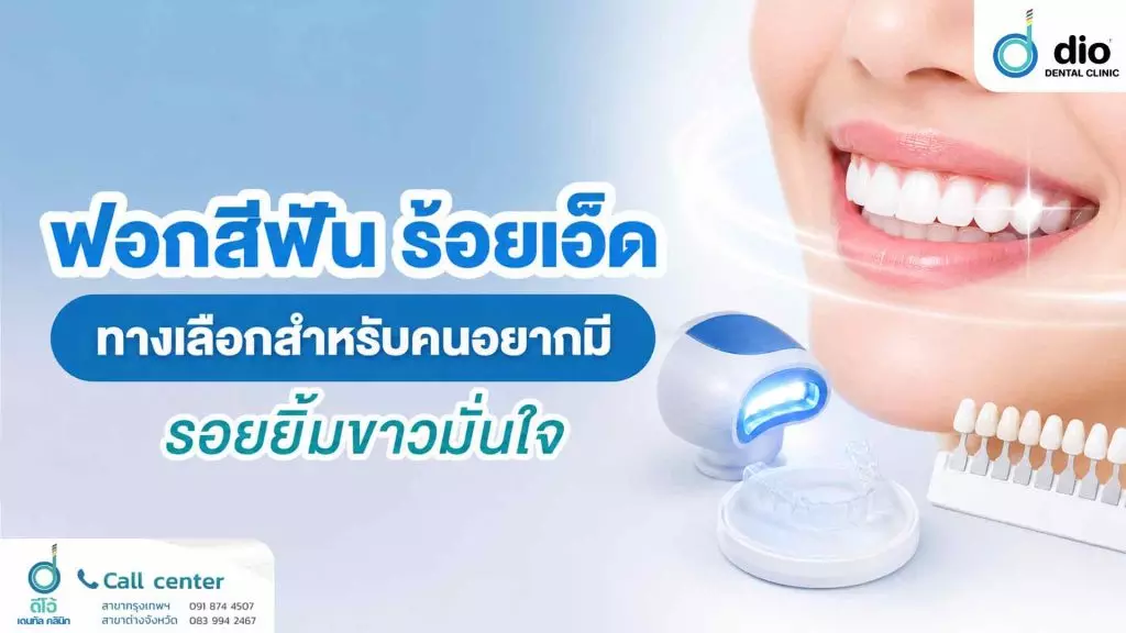ฟอกสีฟัน ร้อยเอ็ด ทางเลือกสำหรับคนอยากมีรอยยิ้มขาวมั่นใจ