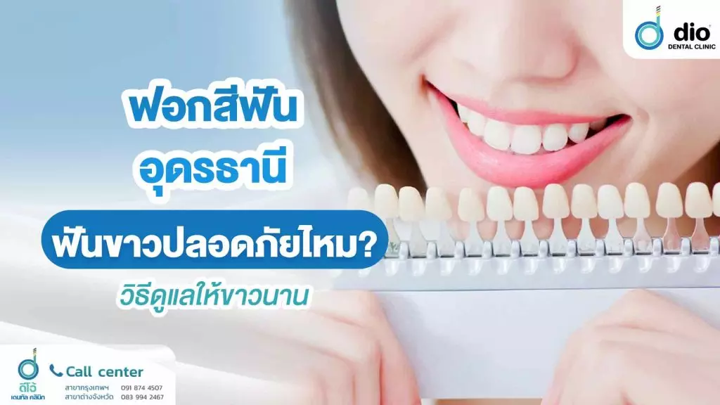 ฟอกสีฟัน อุดรธานี ฟันขาวปลอดภัยไหม? วิธีดูแลให้ขาวนาน