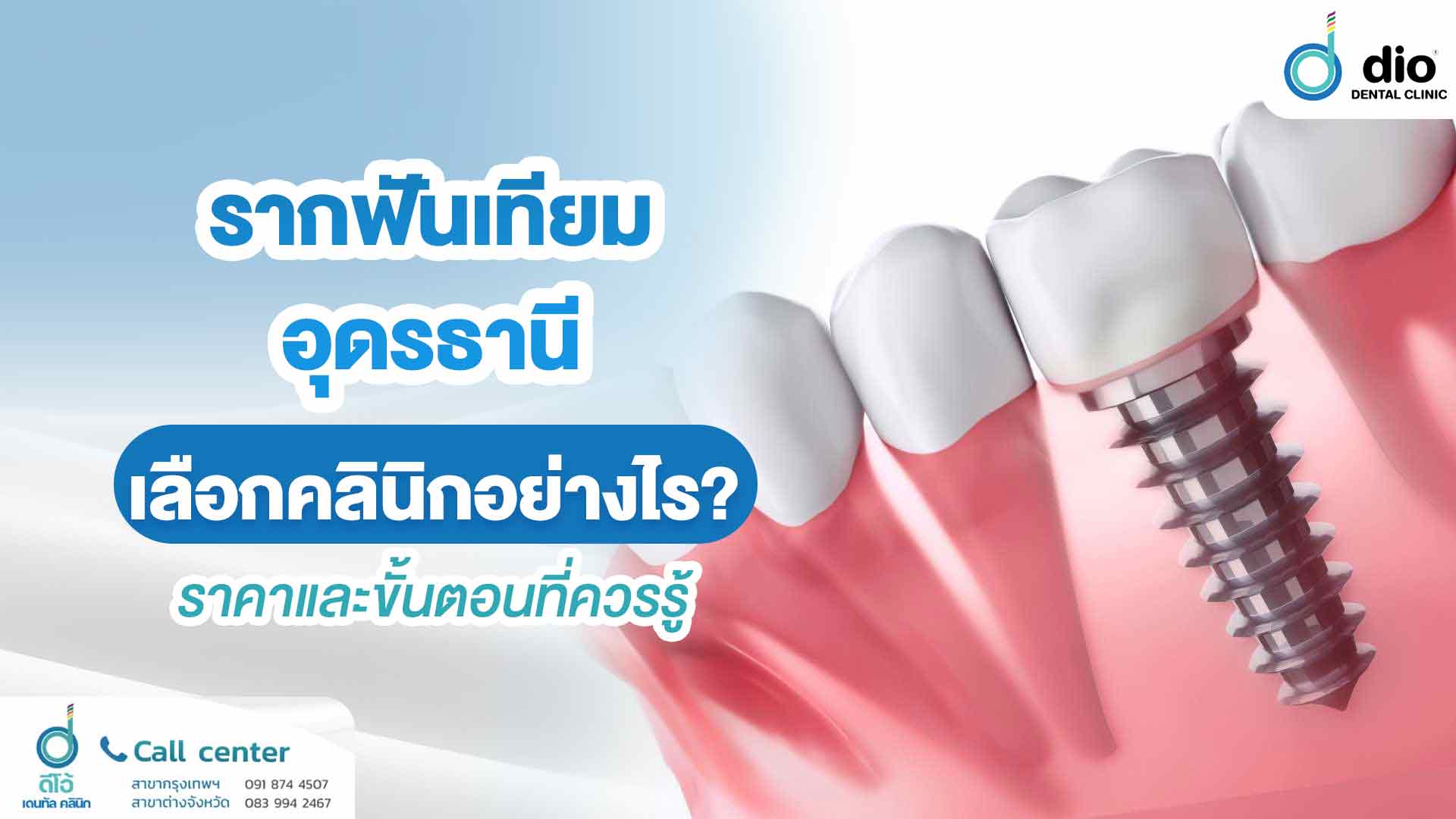 รากฟันเทียม อุดรธานี เลือกคลินิกอย่างไร? ราคาและขั้นตอนที่ควรรู้