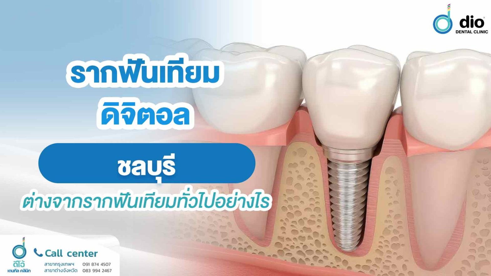 รากฟันเทียมดิจิตอล ชลบุรี ต่างจากรากฟันเทียมทั่วไปอย่างไร