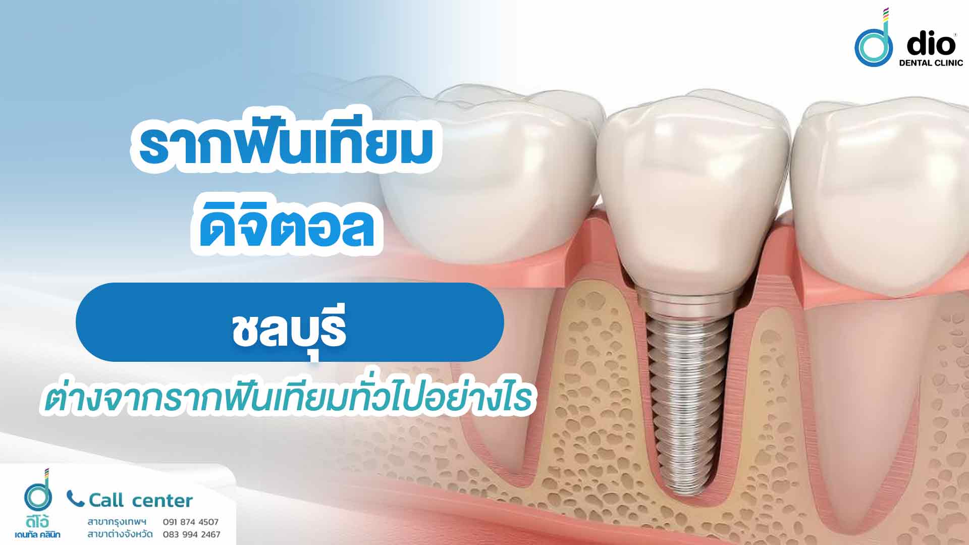 รากฟันเทียมดิจิตอล ชลบุรี ต่างจากรากฟันเทียมทั่วไปอย่างไร