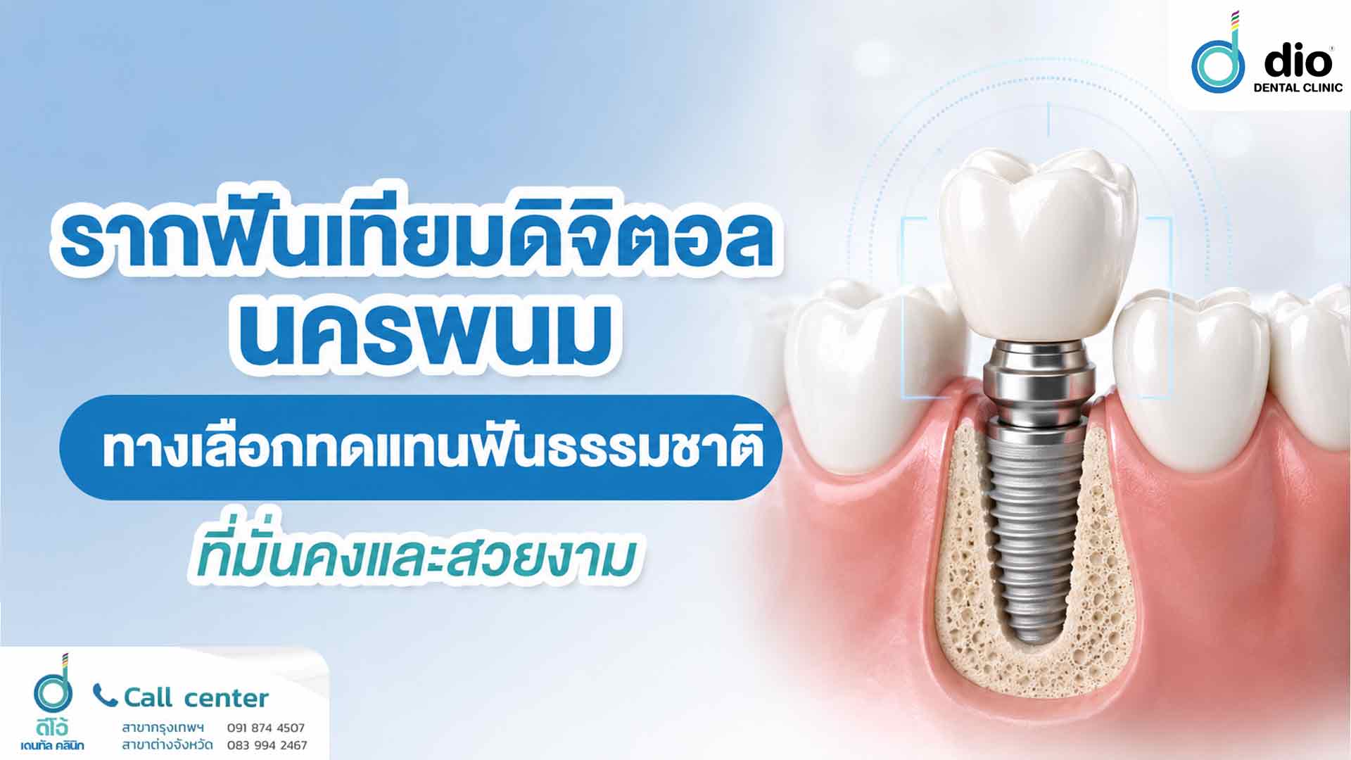 รากฟันเทียมดิจิตอล นครพนม ทางเลือกทดแทนฟันธรรมชาติที่มั่นคงและสวยงาม