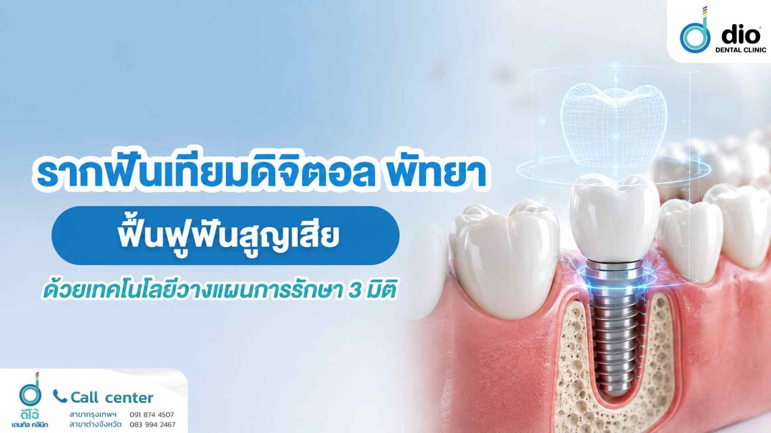รากฟันเทียมดิจิตอล พัทยา ฟื้นฟูฟันสูญเสียด้วยเทคโนโลยีวางแผนการรักษา 3 มิติ