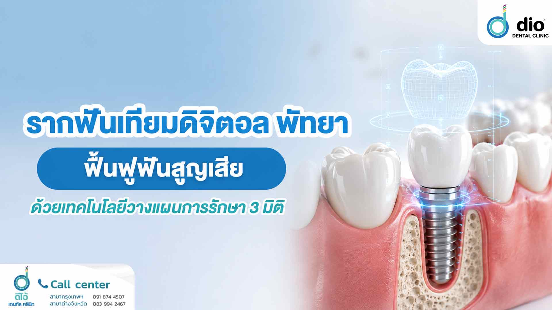 รากฟันเทียมดิจิตอล พัทยา ฟื้นฟูฟันสูญเสียด้วยเทคโนโลยีวางแผนการรักษา 3 มิติ