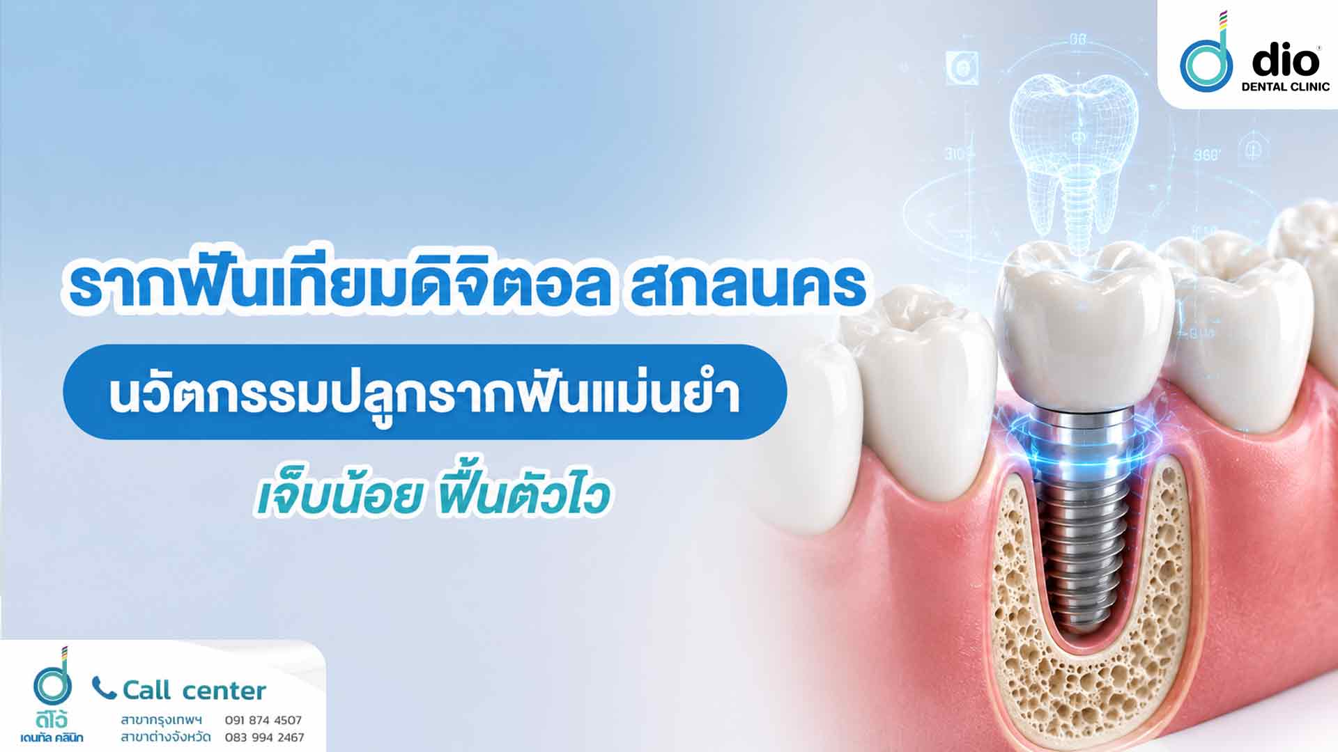 รากฟันเทียมดิจิตอล สกลนคร นวัตกรรมปลูกรากฟันแม่นยำ เจ็บน้อย ฟื้นตัวไว