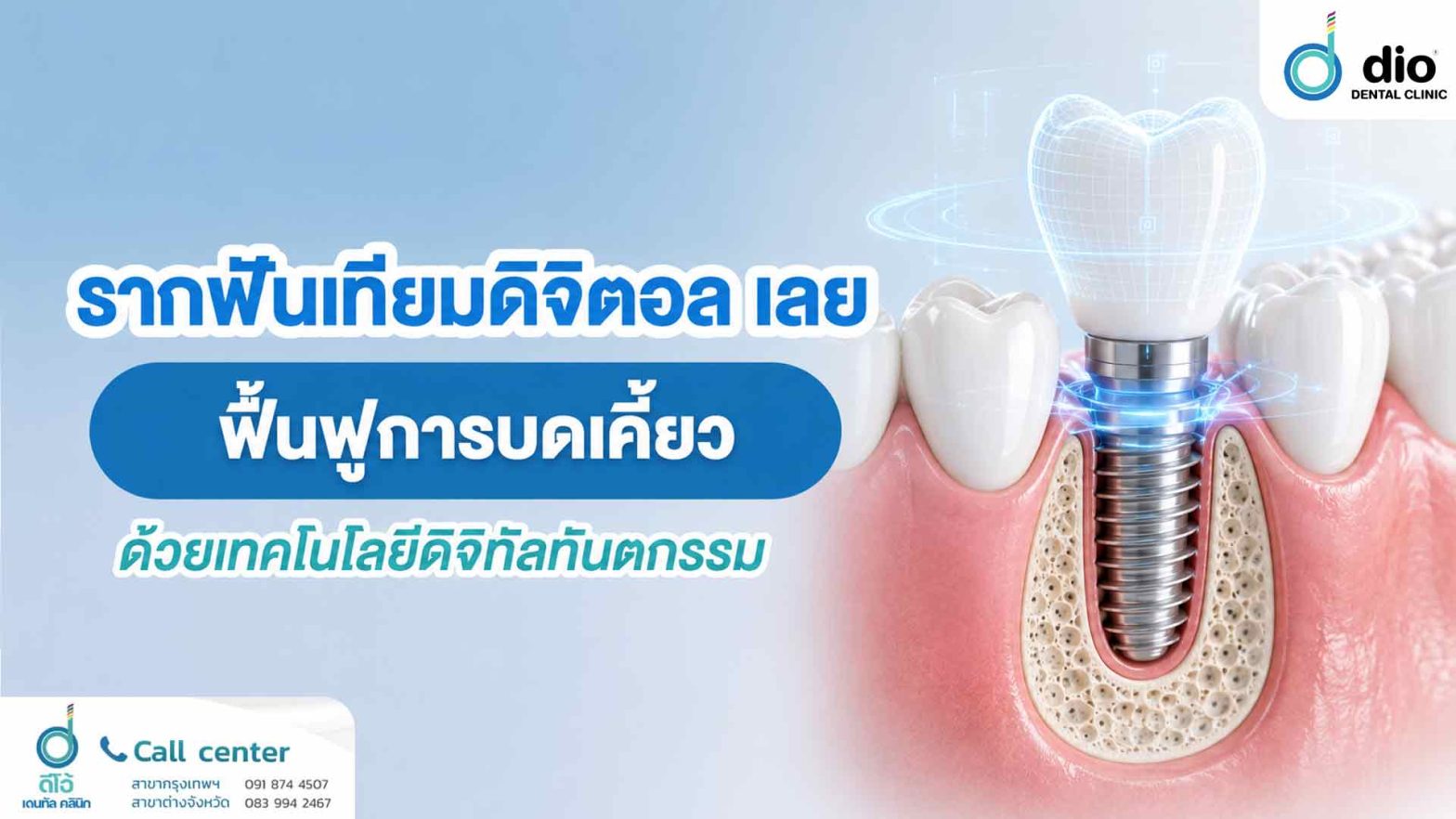 รากฟันเทียมดิจิตอล เลย ฟื้นฟูการบดเคี้ยวด้วยเทคโนโลยีดิจิทัลทันตกรรม