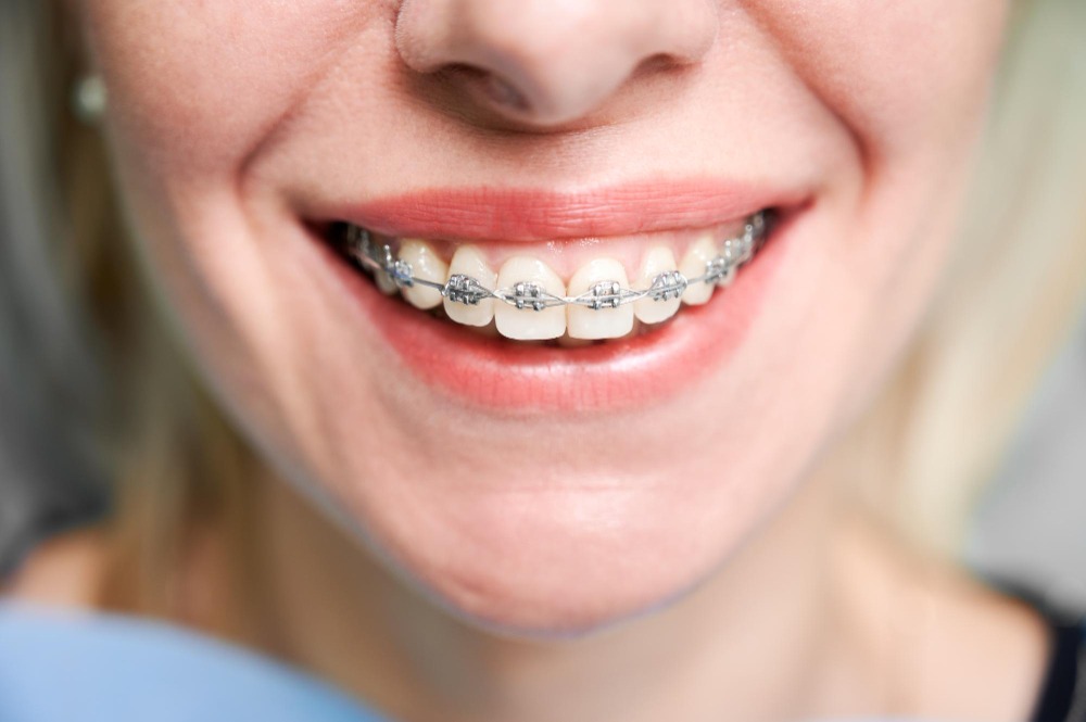 MetalBraces Smile