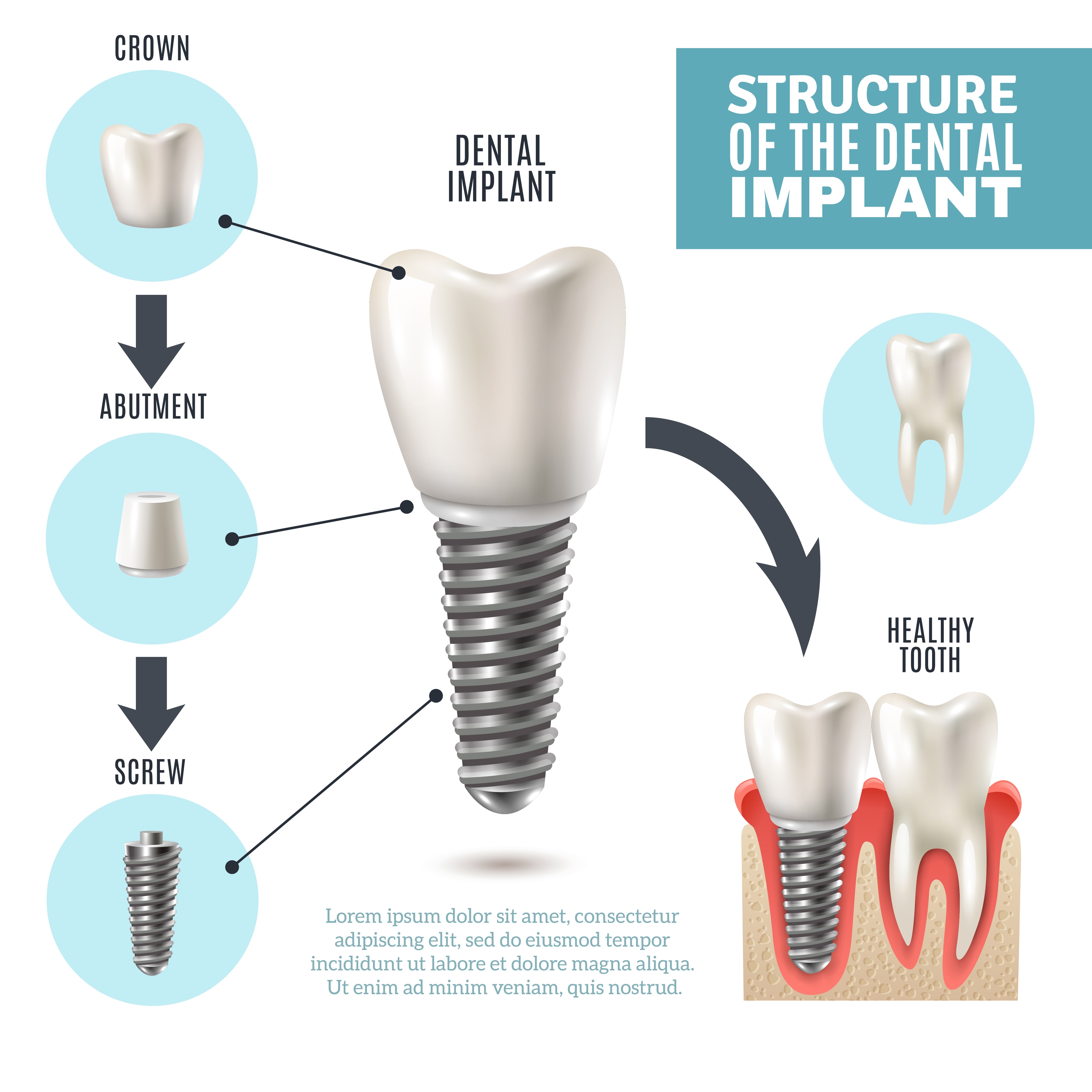 Dental Implant Structure Medical Infographic Poster