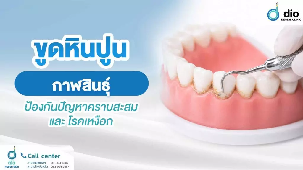 ขูดหินปูน กาฬสินธ์ป้องกันปัญหาคราบสะสม