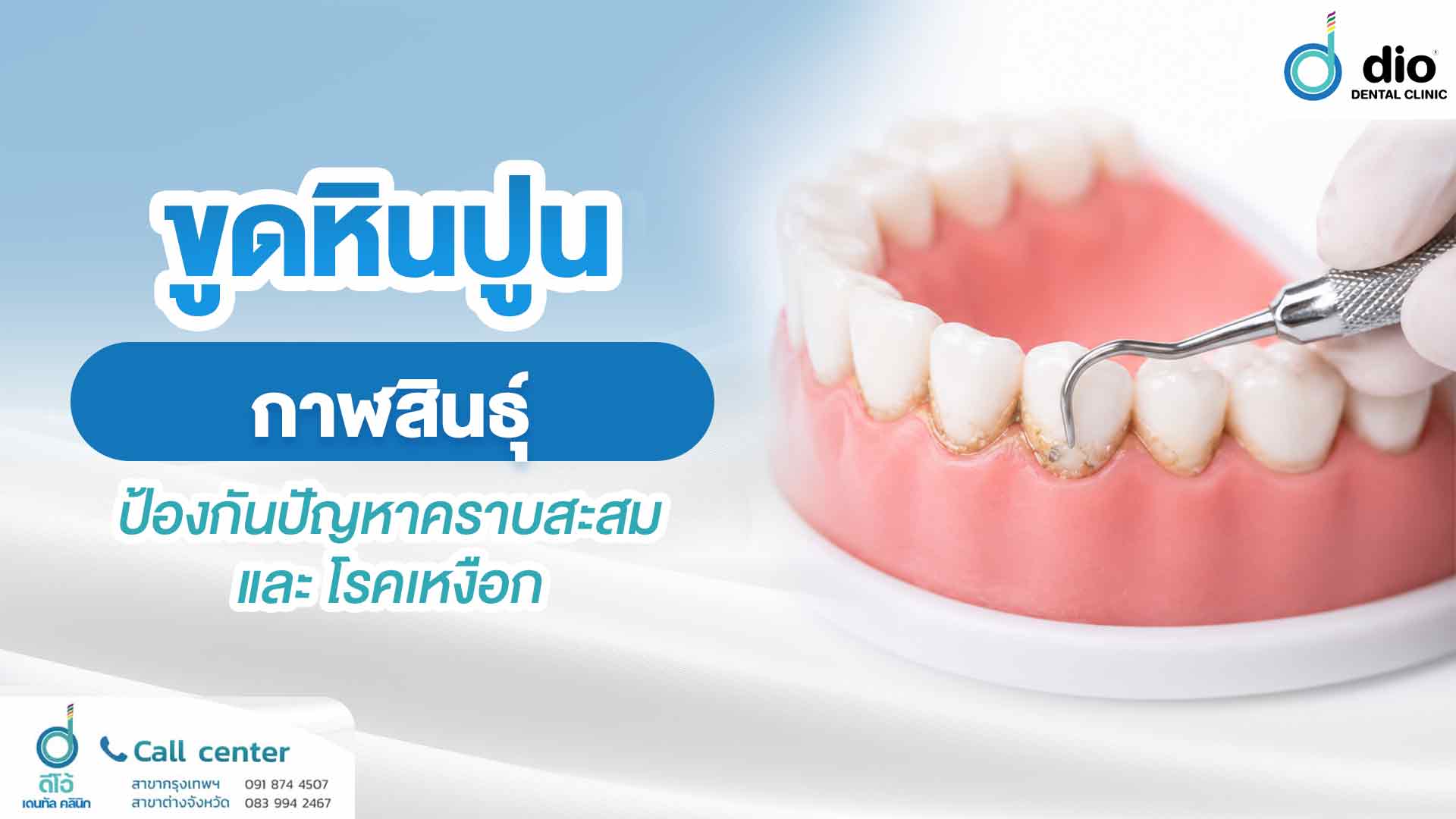 ขูดหินปูน กาฬสินธ์ป้องกันปัญหาคราบสะสม