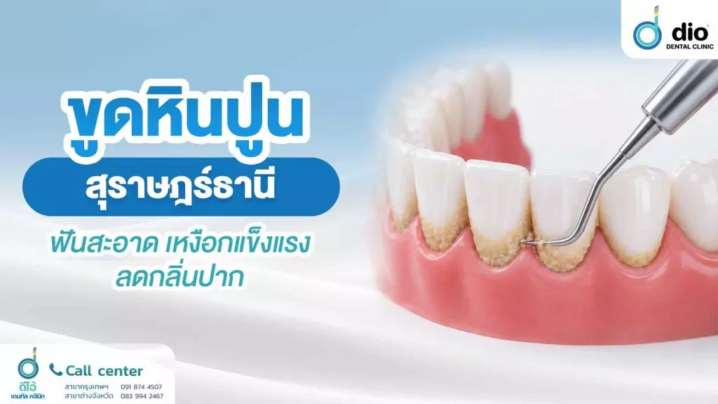 ขูดหินปูน สุราษฎร์ธานี ฟันสะอาด