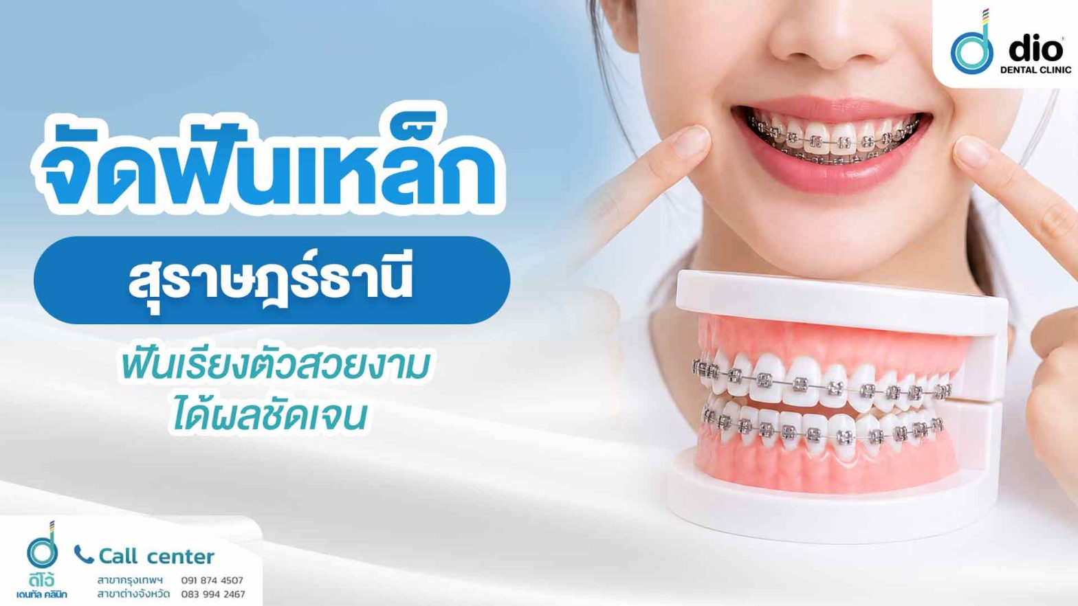 จัดฟันเหล็ก สุราษฎร์ธานี ฟันเรียงตัวสวย
