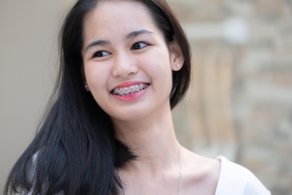 นางแบบจัดฟัน