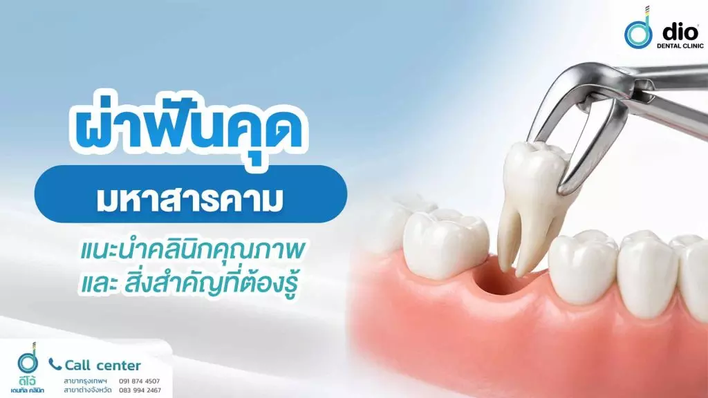 ผ่าฟันคุด มหาสารคาม แนะนำคลินิกคุณภาพ