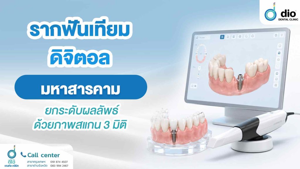 รากฟันเทียมดิจิตอล มหาสารคาม ยกระดับผลลัพธ์