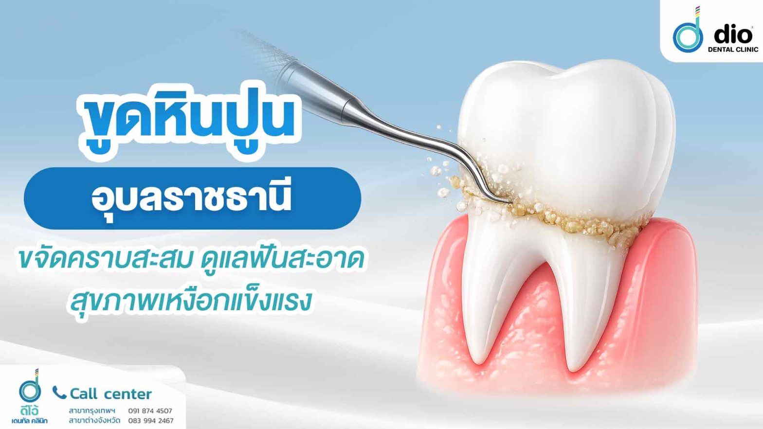 ขูดหินปูน อุบลราชธานี